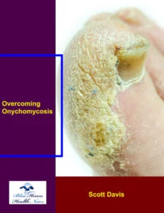 Overcoming Onychomycosis - Nail Fungus Treatment Guide for Clear, Healthy Nails