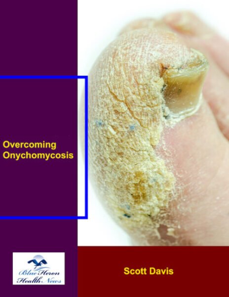 Overcoming Onychomycosis - Nail Fungus Treatment Guide for Clear, Healthy Nails