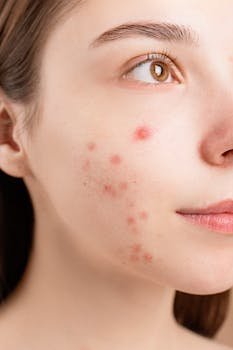 A detailed close-up of a woman's face showing acne blemishes on her skin.